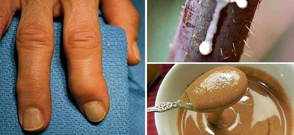 12 Old Fashioned Arthritis Remedies Your Ancestors Used v2